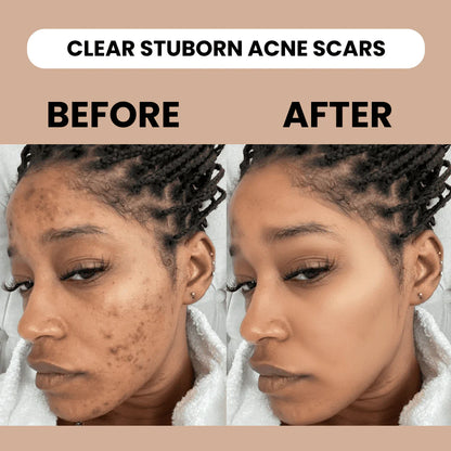 Silicone Scar Stick